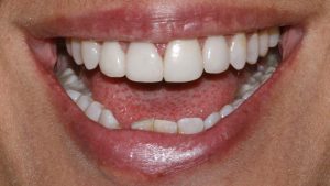 Cosmetic Dentistry Crowns