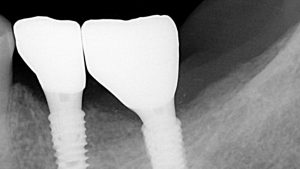 dental-implants-space-after-on-radiograph