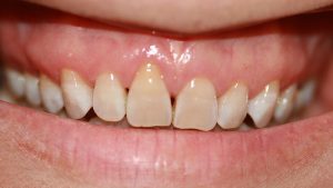 Gum surgery, recession and root exposure